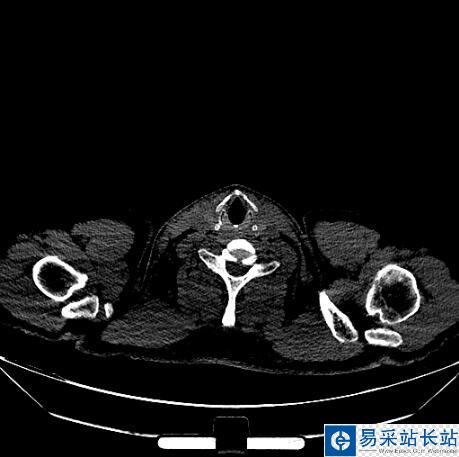 python读取CT医学图像